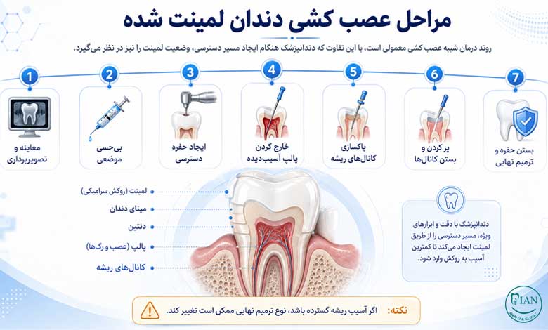 مراحل عصب کشی دندان لمینت شده