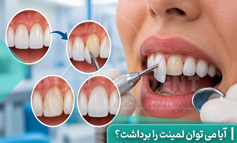 آیا می توان لمینت را برداشت؟