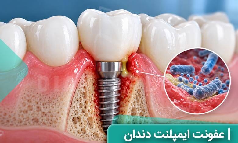 عفونت ایمپلنت دندان؛ علائم و روشهای درمان